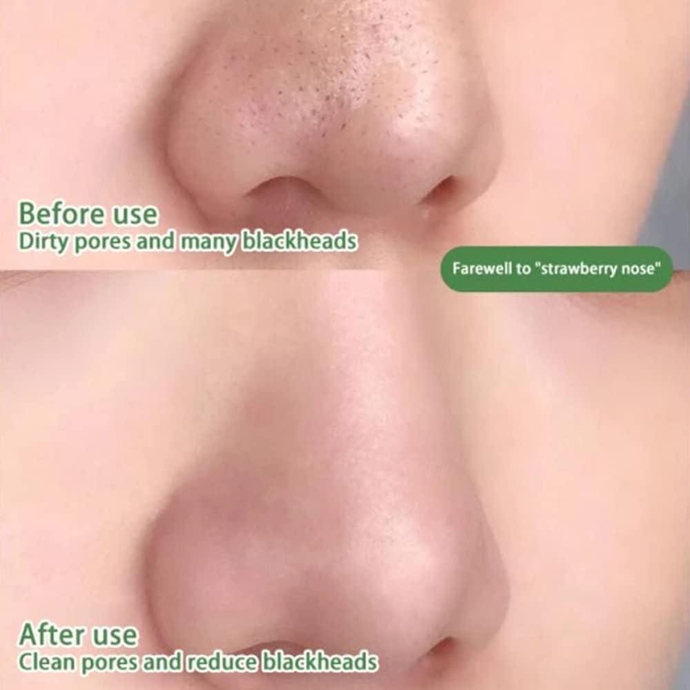 Maska na Čistenie Pórov a Kontrolu Akné 1+1 Zadarmo